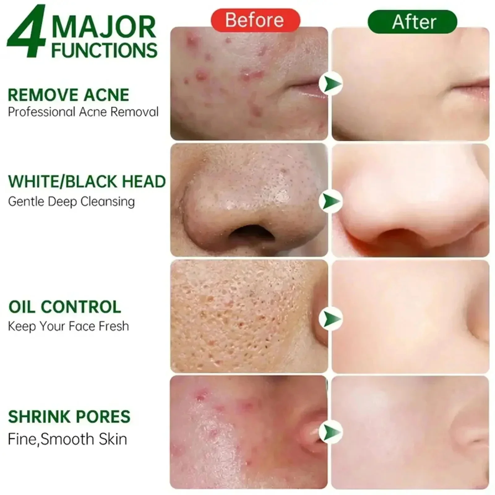 Ácido salicílico poros limpeza - Salicylic Acid Blackhead Remover avaliação e preço