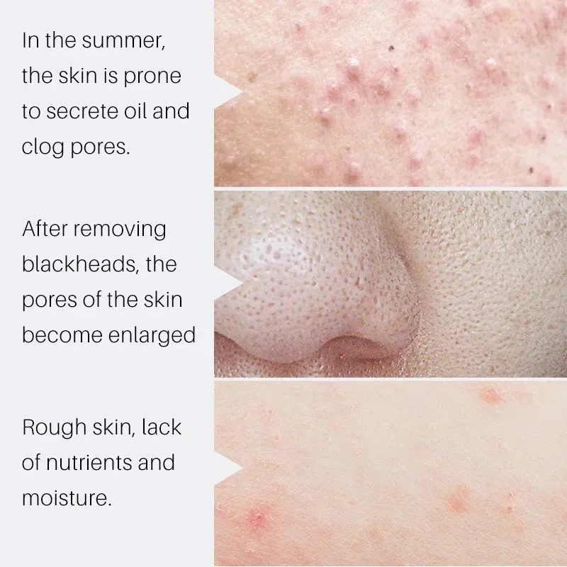 Sérum Redutor de Poros com Áci - Salicylic Acid Blackhead Remover avaliação e preço