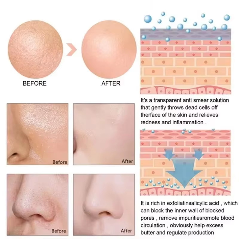 Sérum Redutor de Poros com Áci - Salicylic Acid Blackhead Remover avaliação e preço